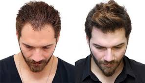 Tudo Sobre Transplante Capilar Masculino: Guia Completo