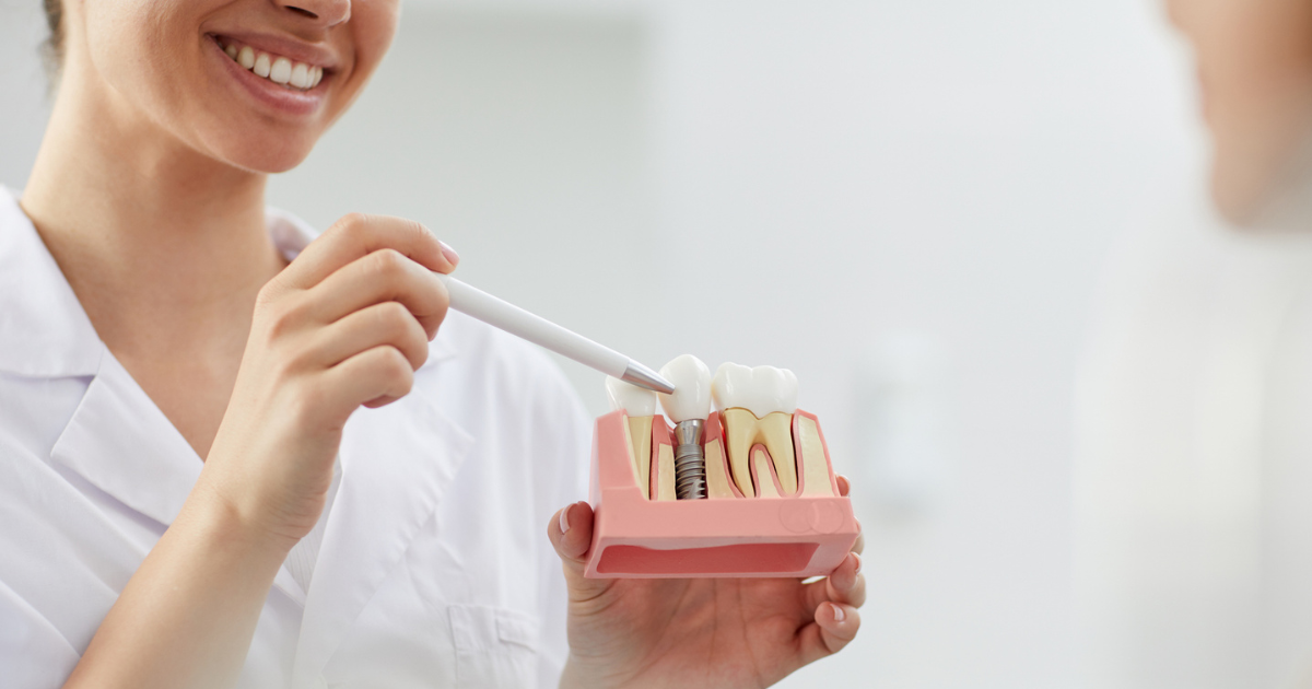 Implantes Dentales: La Solución Duradera para Tu Sonrisa