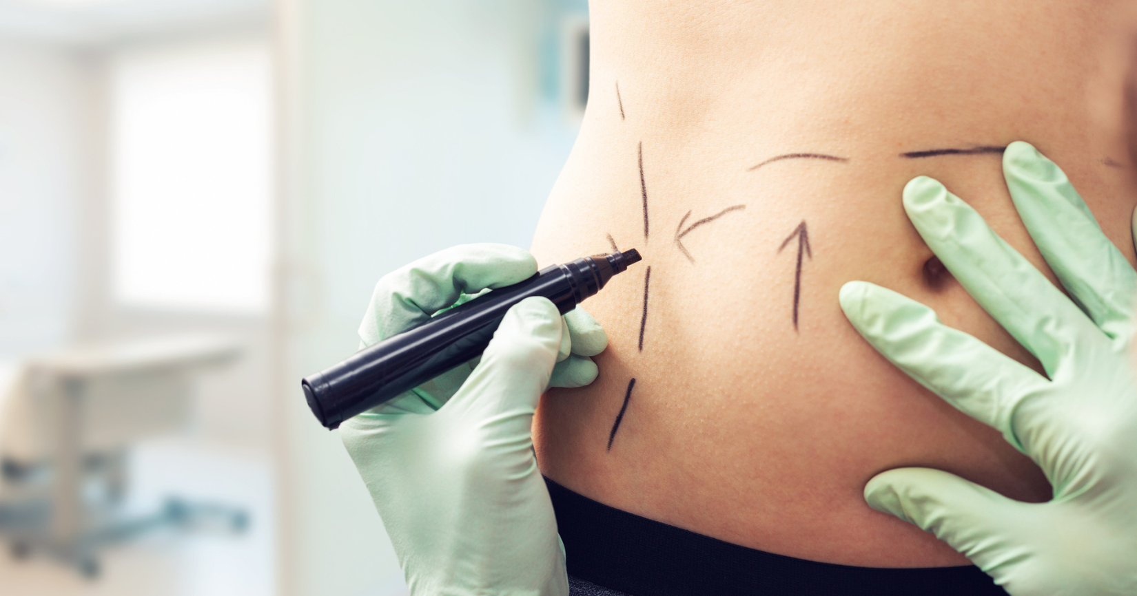 Liposucción: Lo Que Debes Saber Antes De Decidirte