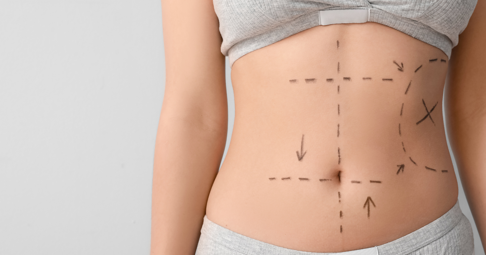 Tummy Tuck: Regain Your Confidence