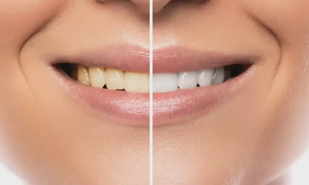 How Teeth Whitening Is Evolving in Modern Dental Care